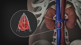 3D Medical Animation still shot showing the Inferior vena cava filter