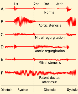 Phonocardiograms from normal and abnormal heart sounds