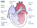 Ventricular septal defect