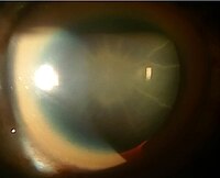 Sunflower cataract and thick KF ring of a 40-year-old male with Wilson's disease and decompensated chronic liver disease