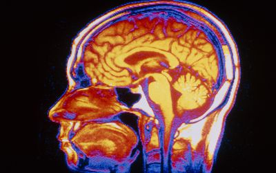 MRI scan of brain