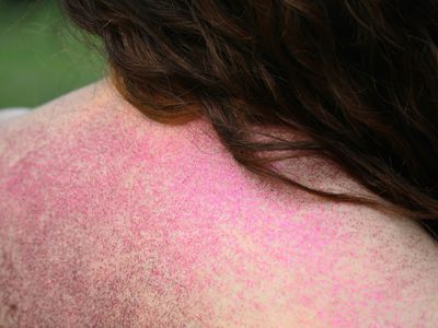 A rash indicating Still's disease.