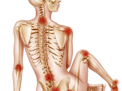 Psoriatic Spondylitis