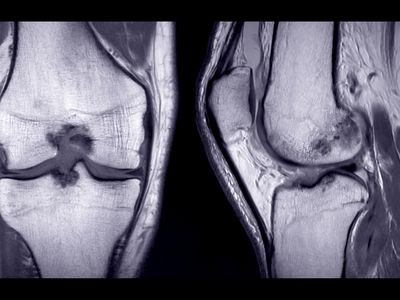 MRI image of knee joint