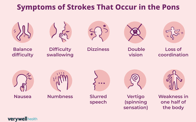 Symptoms of Strokes That Occur in the Pons