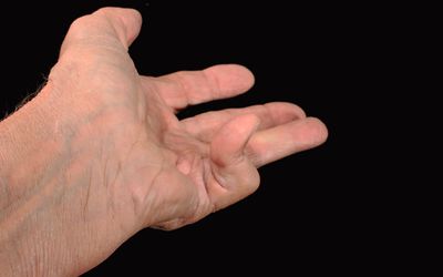 Dupuytren's contracture