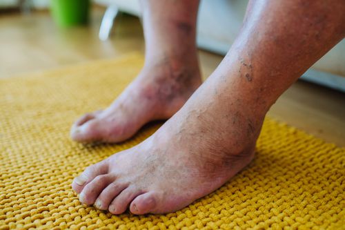 diabetic foot syndrome