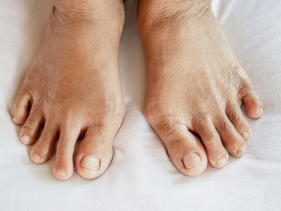 Close-up of feet, which can be affected by arthritis