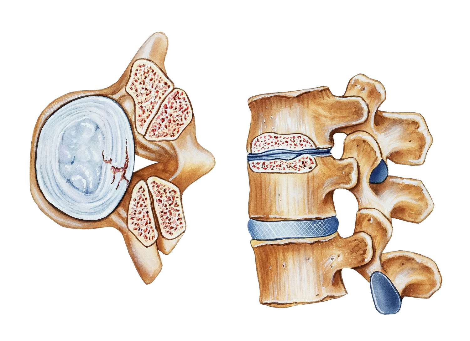 Spinal Stenosis