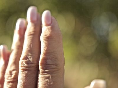 Osteoarthritis nodules on hand 