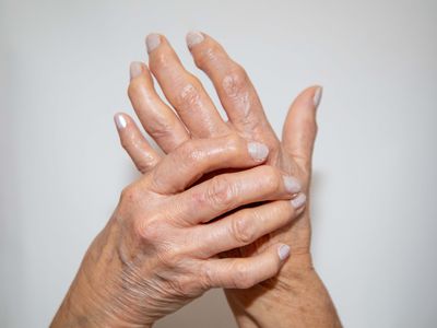 woman suffering from rheumatoid arthritis