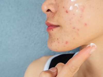 A woman putting cream on acne face