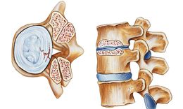 Top-and side-view illustration of spinal stenosis