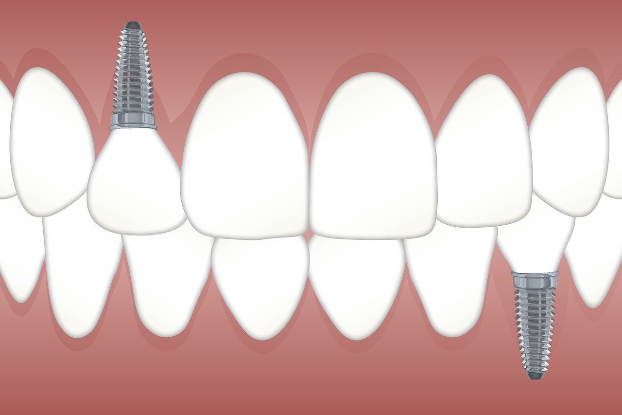 Cheap Dental Implant Near Me Johnstown OH