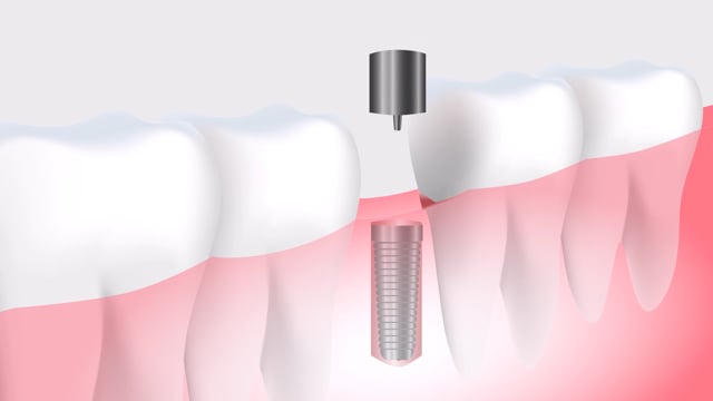 Cheapest Dental Implant Johnstown OH