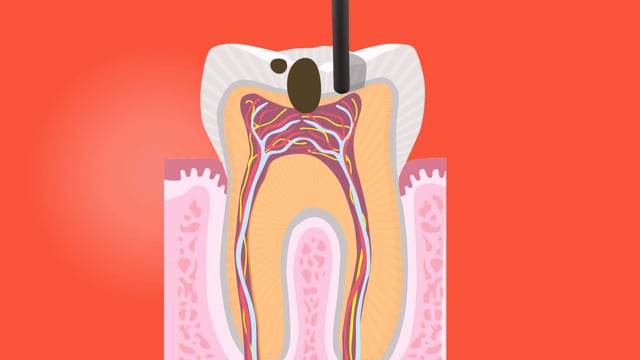 Dental Implant Restoration Johnstown OH