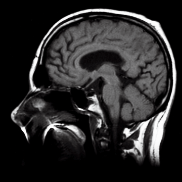 diptych of a brain scan and profile photo