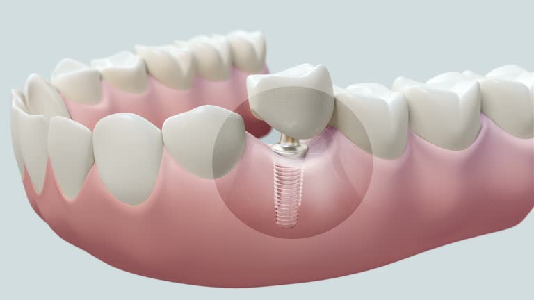 Dental Implants Johnstown OH